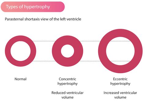 what causes concentric hypertrophy.